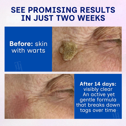 🌟 Official Store | 🛡️ The 'Glue Stick' Secret to Clear Skin! RZXEA™ Solid-Stick Wart Remover.