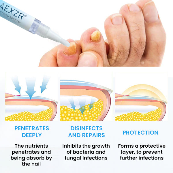 🌟 Official Store | 🛡️ Clear Nails in Just 5 Days! AEXZR® NanoFix Repair Pen