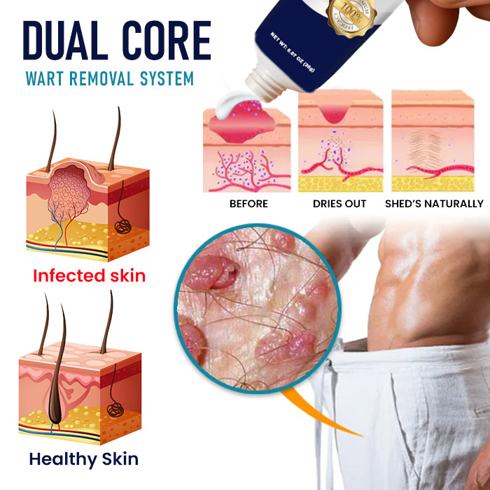 🌟 Official Store | 🛡️ Painless Removal in Just 3 Days! Clinical-Grade Sensitive Formula. RZXEA™ Genital Warts Remover Cream