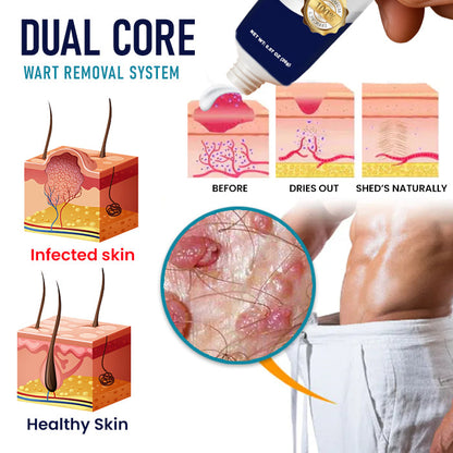 🌟 Official Store | 🛡️ Painless Removal in Just 3 Days! Clinical-Grade Sensitive Formula. RZXEA™ Genital Warts Remover Cream