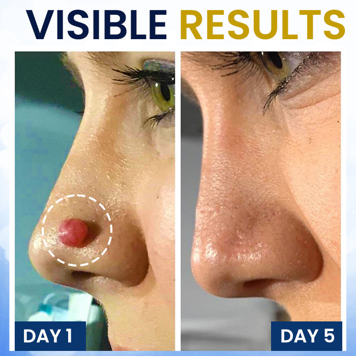 ❄️ Freeze Blemishes Instantly! | ⏱️ Flawless in Days! | AEXZR® Skin Tag Cryo Treatment Spray