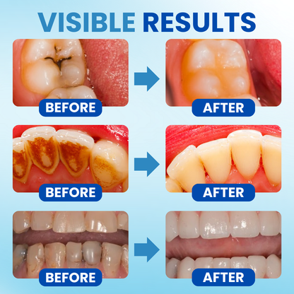 🌟 Official Store | 🛡️ Rebuild Enamel With Postbiotics Science! AEXZR® Anti-Plaque Oral Serum