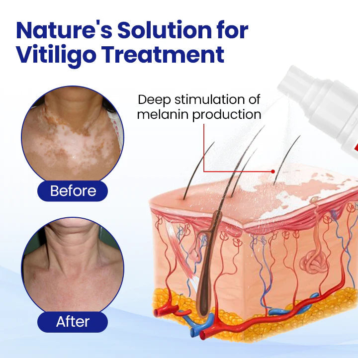 ✨ From Uneven to Radiant! | ⏱️ Fade White Patches Fast! | AEXZR® Vitiligo Treatment Spray