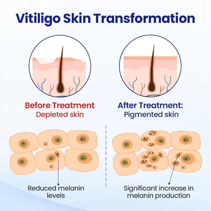 ✨ From Uneven to Radiant! | ⏱️ Fade White Patches Fast! | AEXZR® Vitiligo Treatment Spray