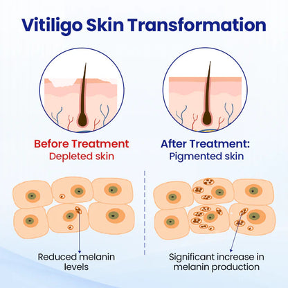 ✨ From Uneven to Radiant! | ⏱️ Fade White Patches Fast! | AEXZR® Vitiligo Treatment Spray