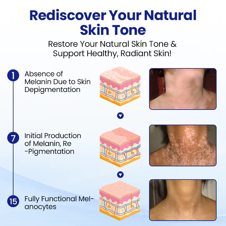 ✨ From Uneven to Radiant! | ⏱️ Fade White Patches Fast! | AEXZR® Vitiligo Treatment Spray