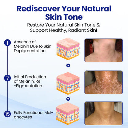✨ From Uneven to Radiant! | ⏱️ Fade White Patches Fast! | AEXZR® Vitiligo Treatment Spray